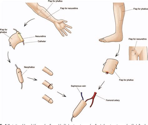 Phalloplasty: A Review of Techniques and Outcomes .